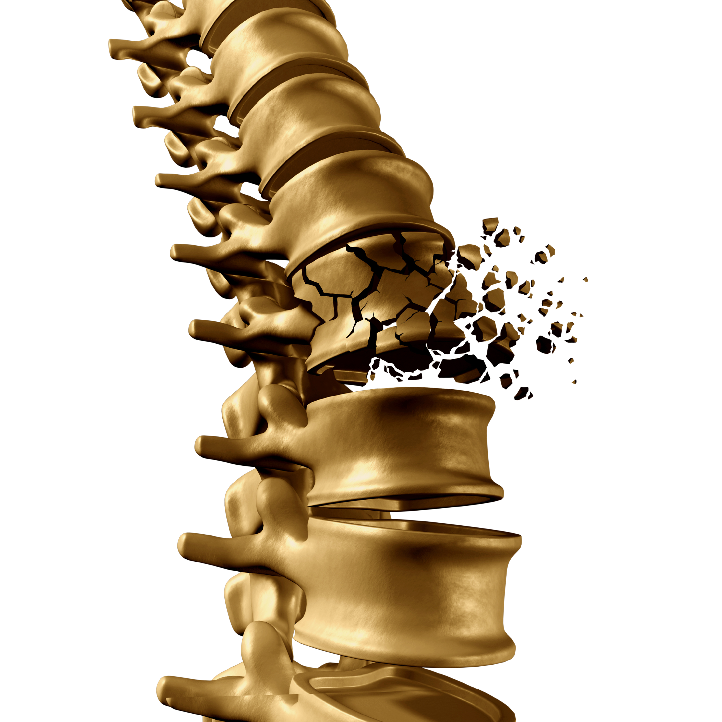 Osteoporosis | Hartland Movement Center | Hartland, WI Osteoporosis | Hartland Movement Center | Hartland, WI