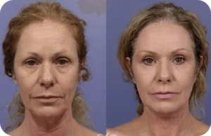 Synever Ultra Lift Benefits